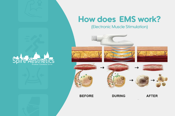 EMS treatment for post pregnancy weight loss treatment Welwyn Garden City