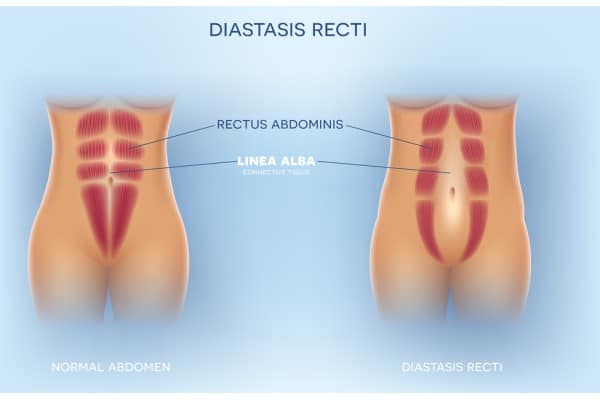What Non-Surgical Options Are Available for Diastasis Recti Welwyn Garden City?