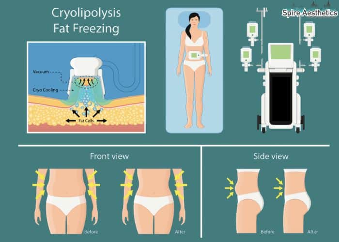 Image of diet and fat freezing combined for best results for Spire Aesthetics Welwyn Garden City