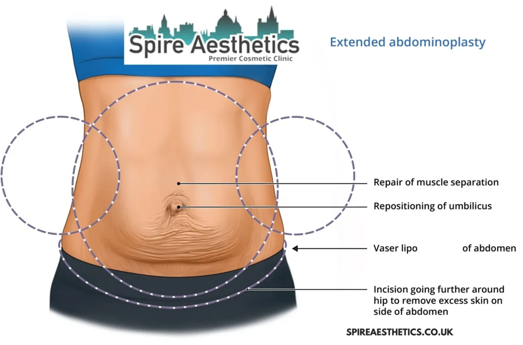 Understanding Loose Skin After Gastric Band Welwyn Garden City Surgery and HIFU Treatment