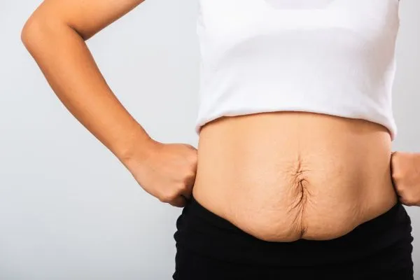 Image of a woman's stomach after weight loss with sagging skin following a gastric band Welwyn Garden City