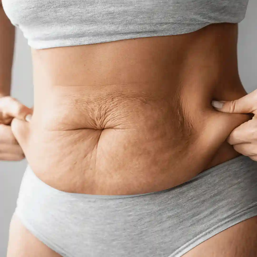 Is It Normal to Have Loose Skin After Pregnancy Welwyn Garden City?