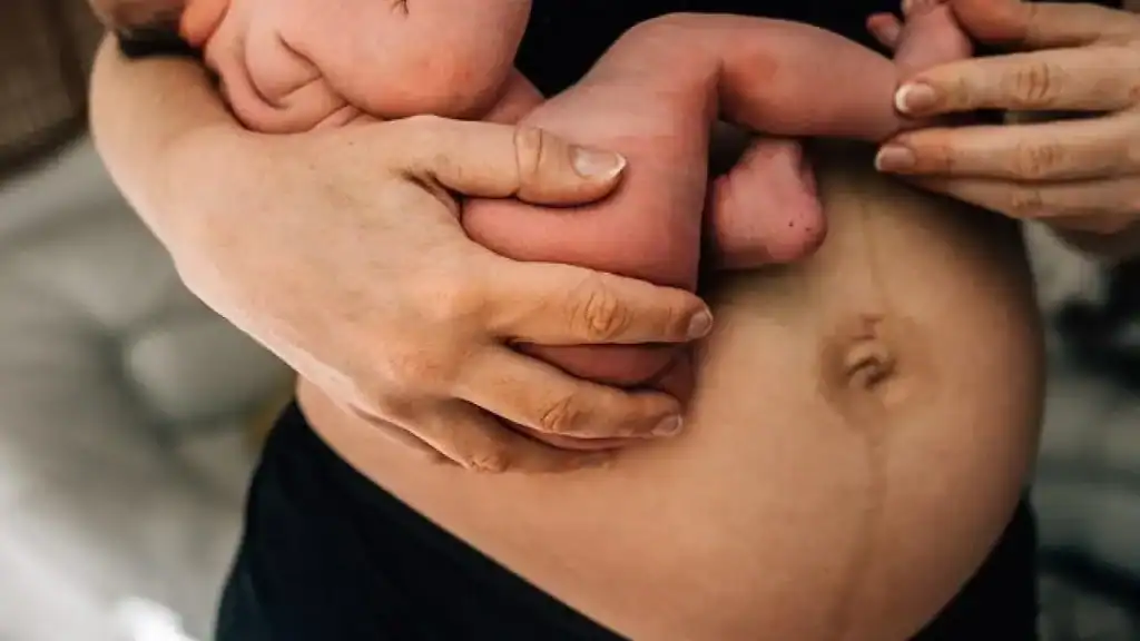 Why Is My Stomach Still Big After Pregnancy Welwyn Garden City?
