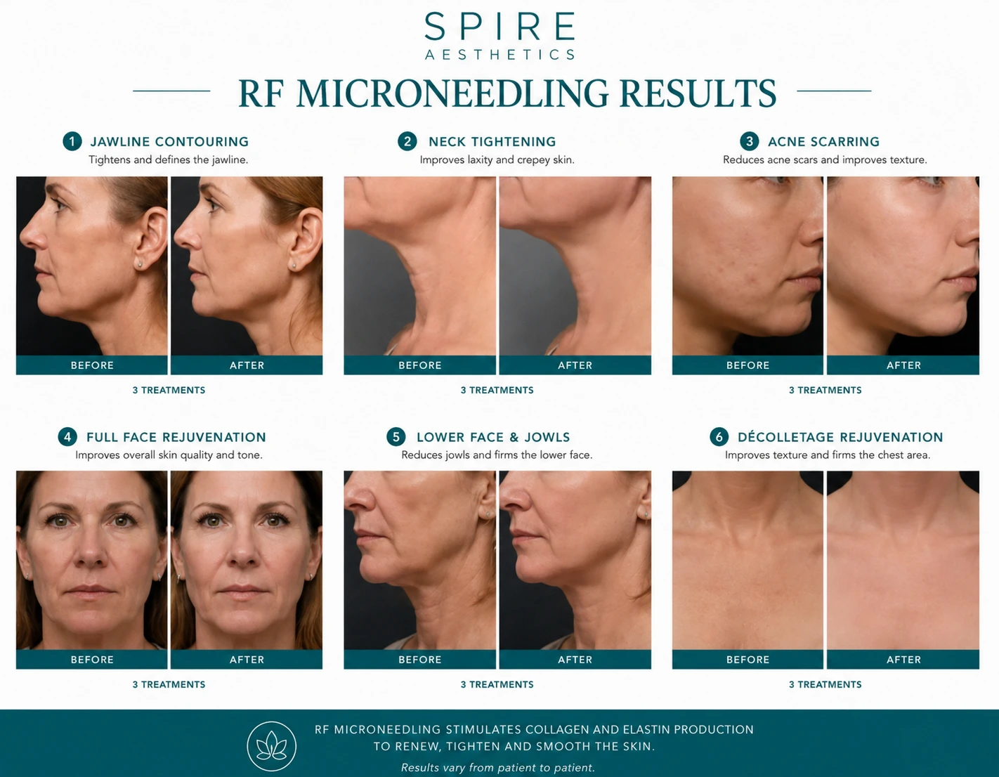 RF Microneedling Skin tightening Welwyn Garden City results