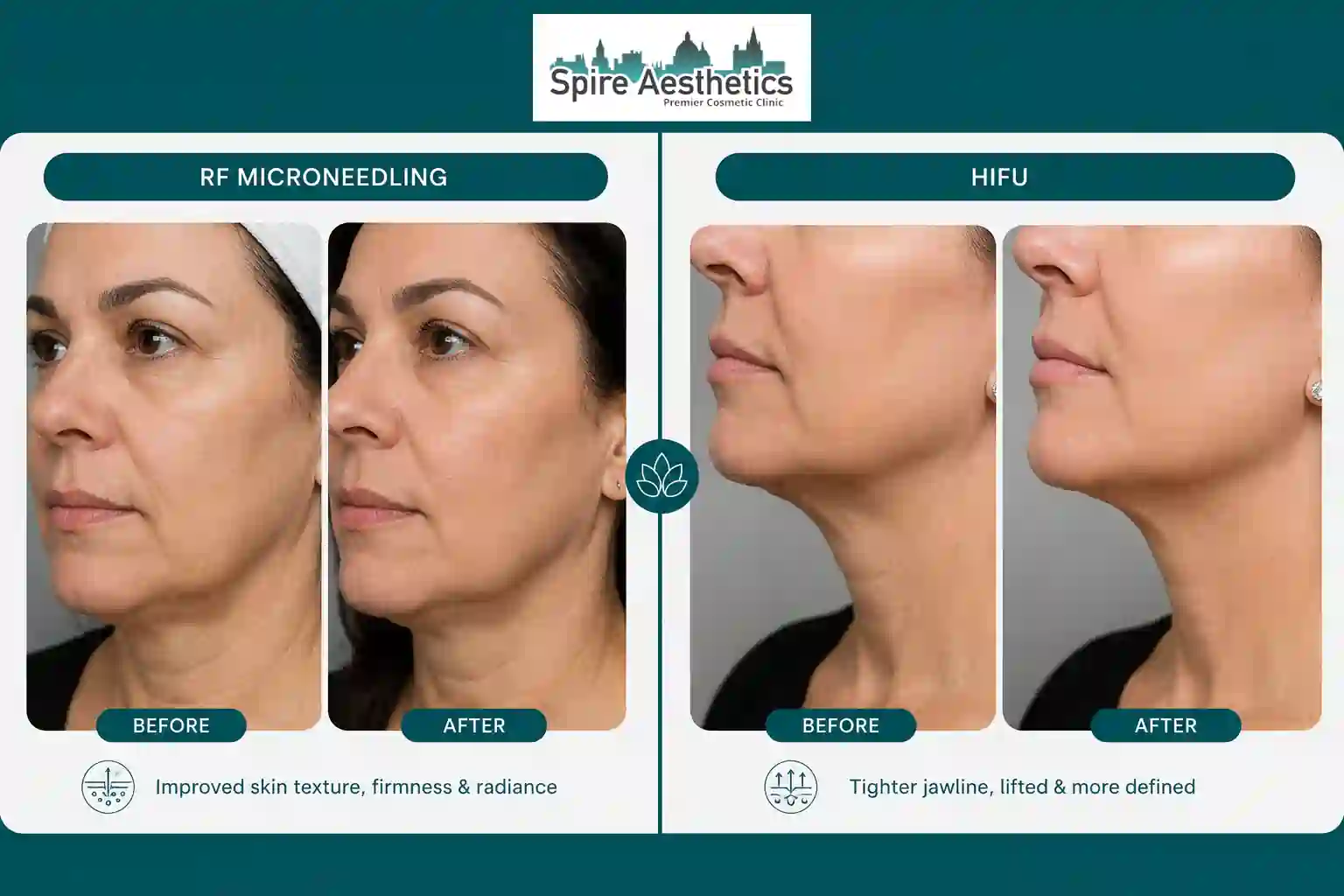 Can RF Microneedling and HIFU Be Combined Welwyn Garden City?