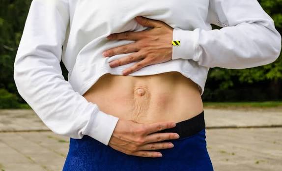 When Could Diastasis Recti Be the Missing Piece of the Puzzle Welwyn Garden City?