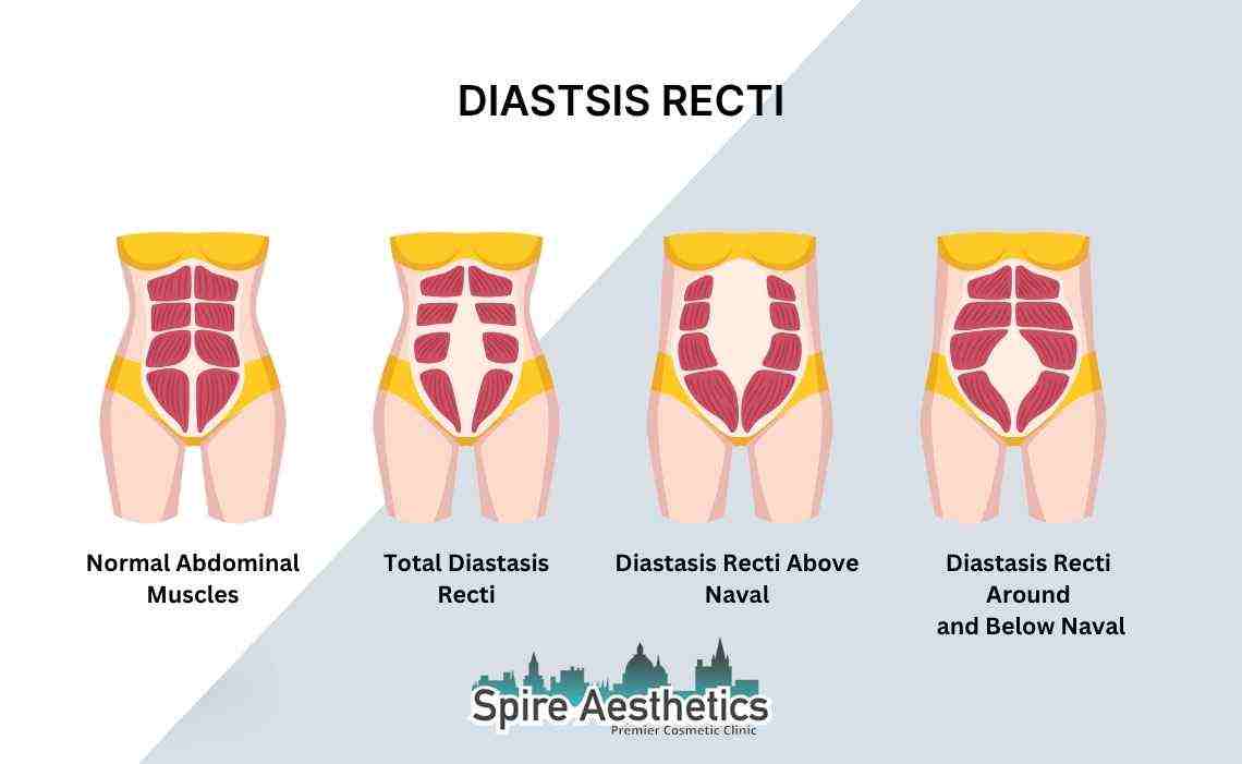 Is Non-Surgical Diastasis Recti Treatment Right for You? Common Concerns Answered Welwyn Garden City